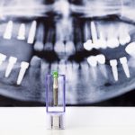 Implanty zębów – skuteczny sposób na walkę z brakami w uzębieniu